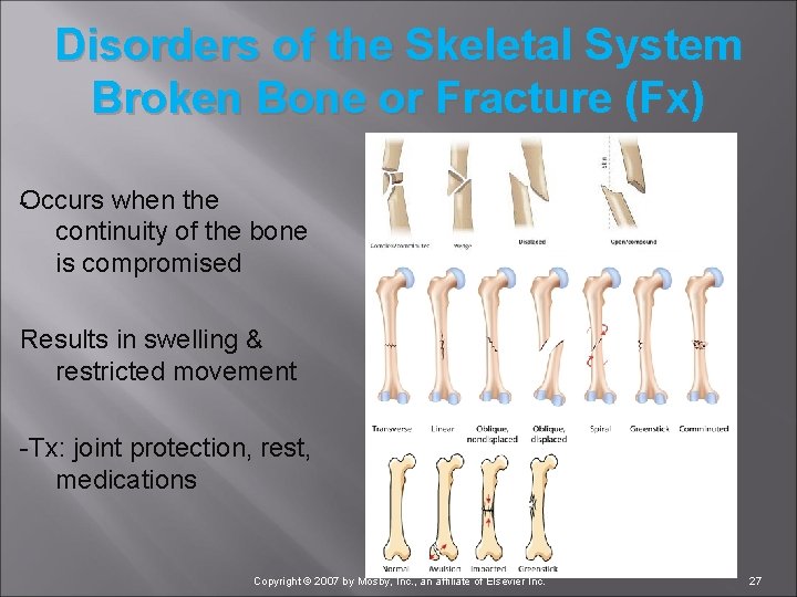 Disorders of the Skeletal System Broken Bone or Fracture (Fx) Occurs when the continuity