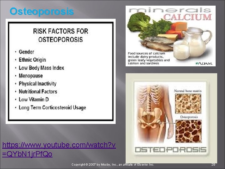 Osteoporosis https: //www. youtube. com/watch? v =QYb. N 1 jr. Pf. Qo Copyright ©