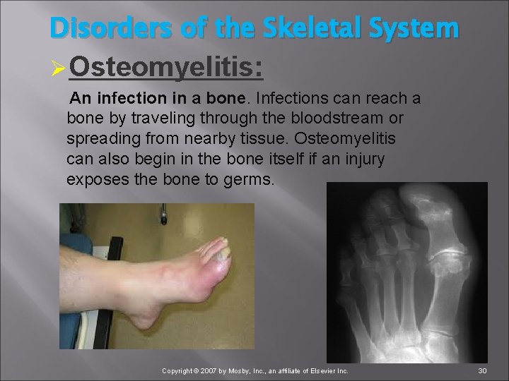 Disorders of the Skeletal System ØOsteomyelitis: An infection in a bone. Infections can reach