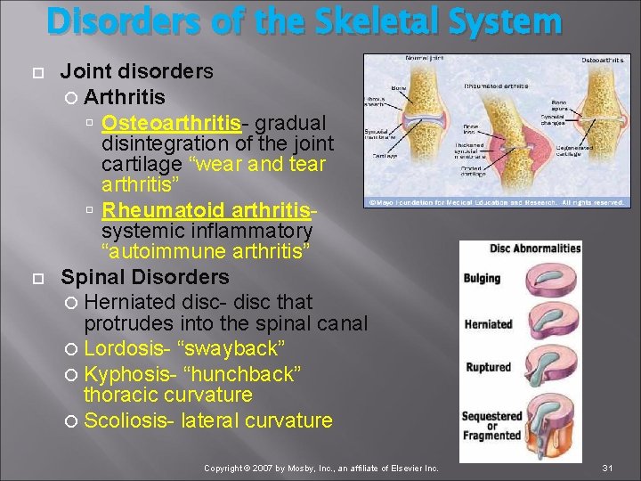 Disorders of the Skeletal System Joint disorders Arthritis Osteoarthritis gradual disintegration of the joint