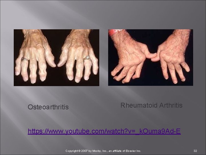 Osteoarthritis Rheumatoid Arthritis https: //www. youtube. com/watch? v=_k. Ouma 9 Ad E Copyright ©