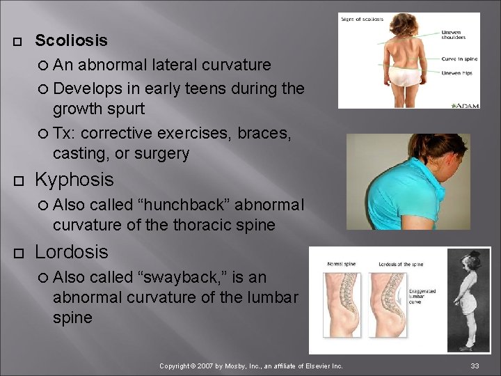  Scoliosis An abnormal lateral curvature Develops in early teens during the growth spurt