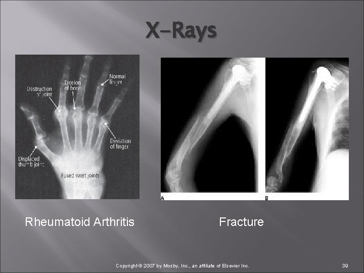 X-Rays Rheumatoid Arthritis Fracture Copyright © 2007 by Mosby, Inc. , an affiliate of