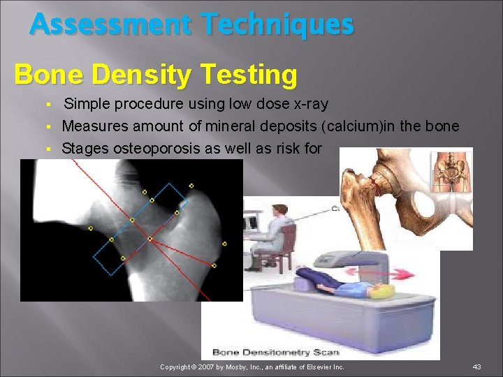Assessment Techniques Bone Density Testing Simple procedure using low dose x ray § Measures