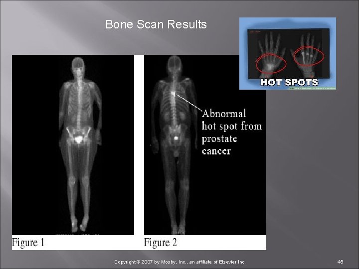 Bone Scan Results Copyright © 2007 by Mosby, Inc. , an affiliate of Elsevier