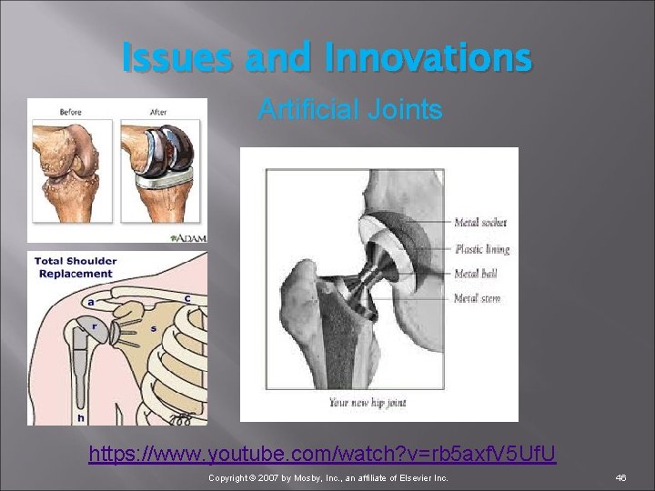 Issues and Innovations Artificial Joints https: //www. youtube. com/watch? v=rb 5 axf. V 5
