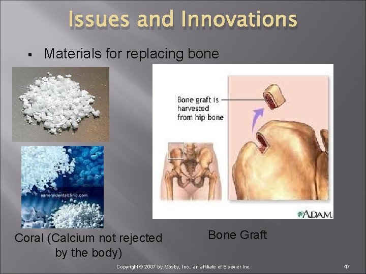 Issues and Innovations § Materials for replacing bone Coral (Calcium not rejected by the