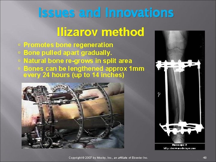 Issues and Innovations Ilizarov method Promotes bone regeneration Bone pulled apart gradually. Natural bone