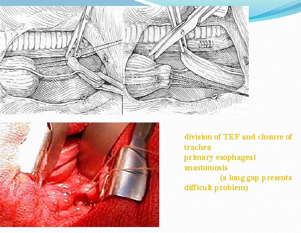 division of TEF and closure of trachea primary esophageal anastomosis (a long gap presents