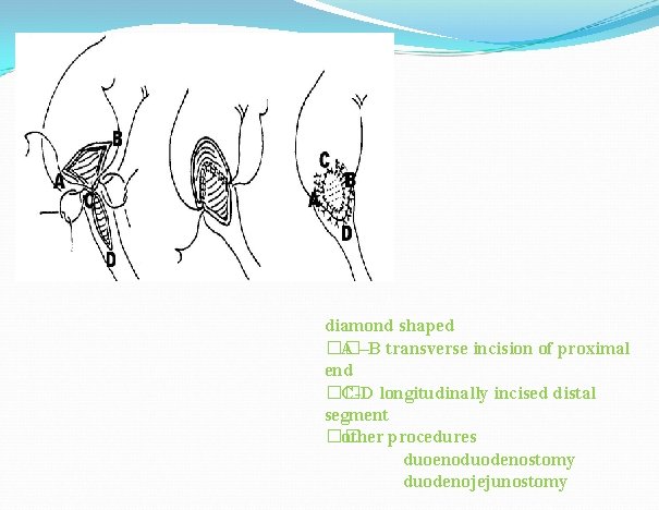 diamond shaped �� A –B transverse incision of proximal end �� C-D longitudinally incised