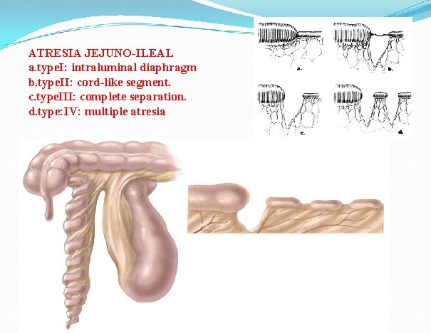 ATRESIA JEJUNO-ILEAL a. type. I: intraluminal diaphragm b. type. II: cord-like segment. c. type.