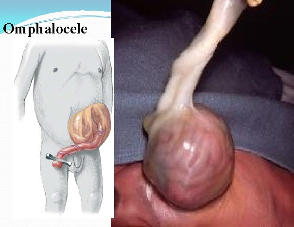 Omphalocele 