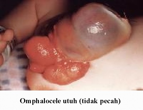 Omphalocele utuh (tidak pecah) 