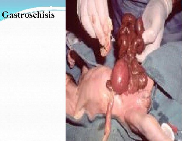 Gastroschisis 