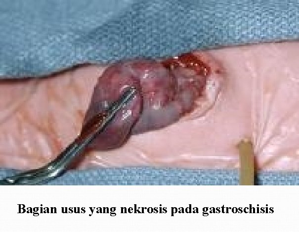 Bagian usus yang nekrosis pada gastroschisis 