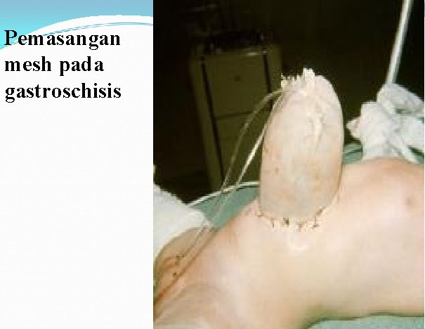 Pemasangan mesh pada gastroschisis 