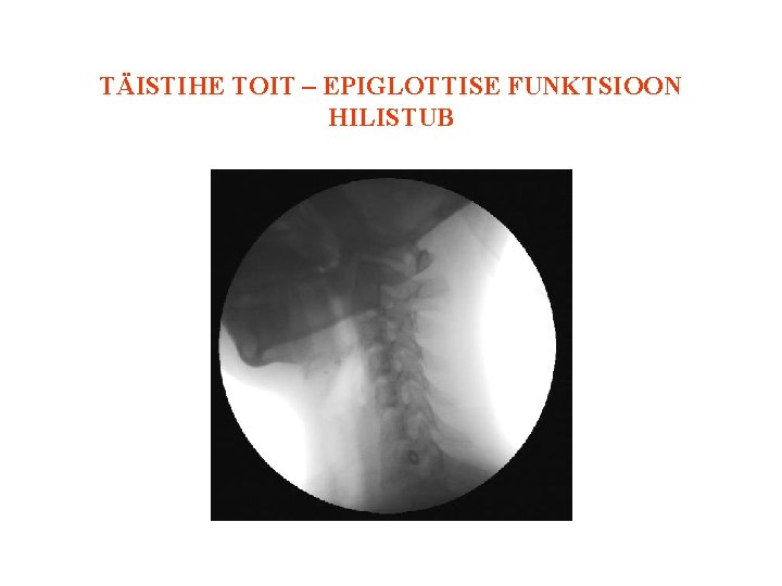 TÄISTIHE TOIT – EPIGLOTTISE FUNKTSIOON HILISTUB 