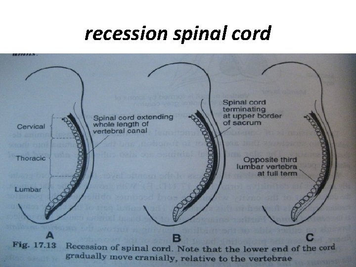recession spinal cord 