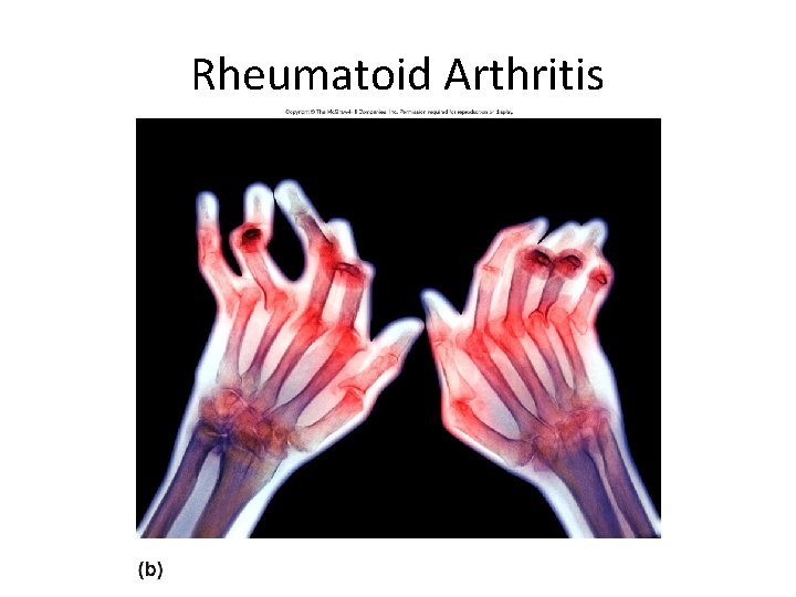 Rheumatoid Arthritis 