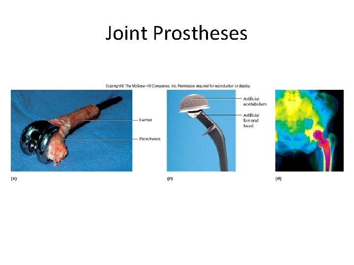 Joint Prostheses Joint Prostheses