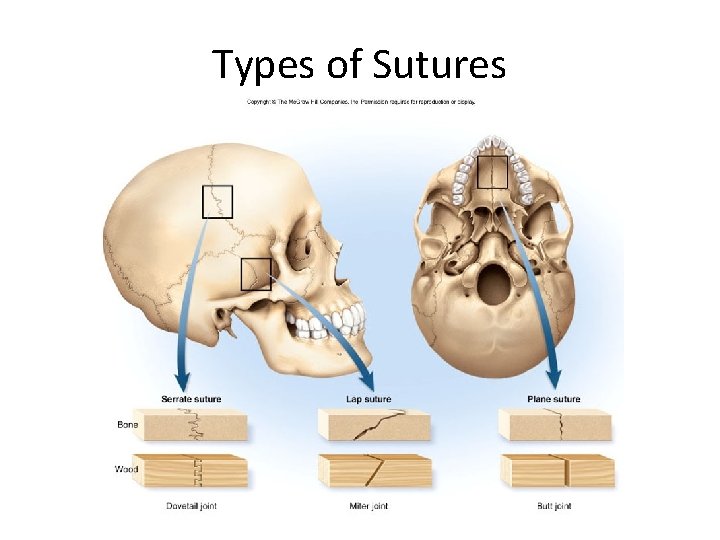 Types of Sutures Types of Sutures