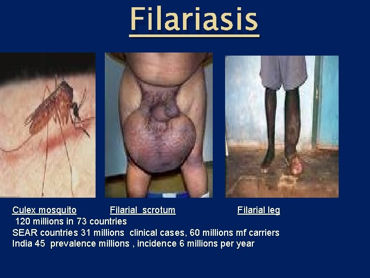 Filariasis Culex mosquito Filarial scrotum Filarial leg 120 millions in 73 countries SEAR countries