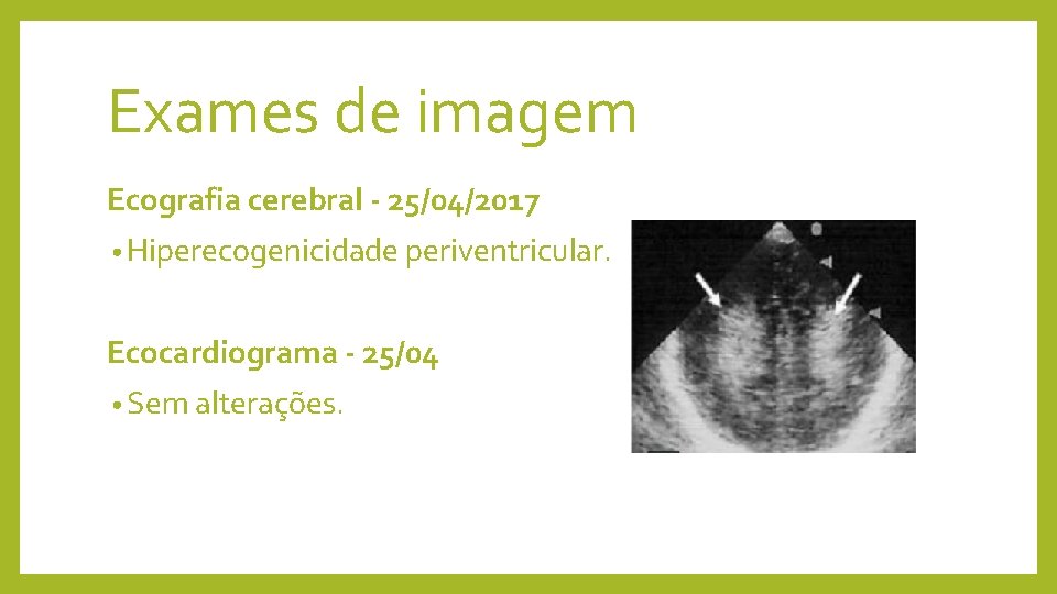 Exames de imagem Ecografia cerebral - 25/04/2017 • Hiperecogenicidade periventricular. Ecocardiograma - 25/04 •