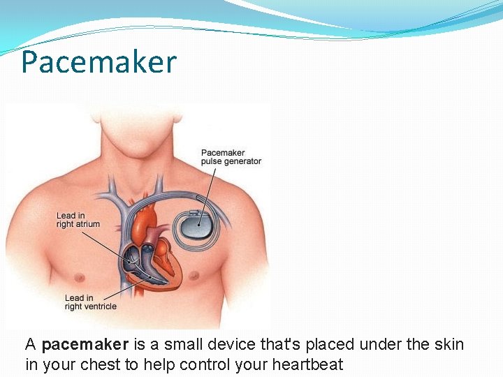 Pacemaker A pacemaker is a small device that's placed under the skin in your