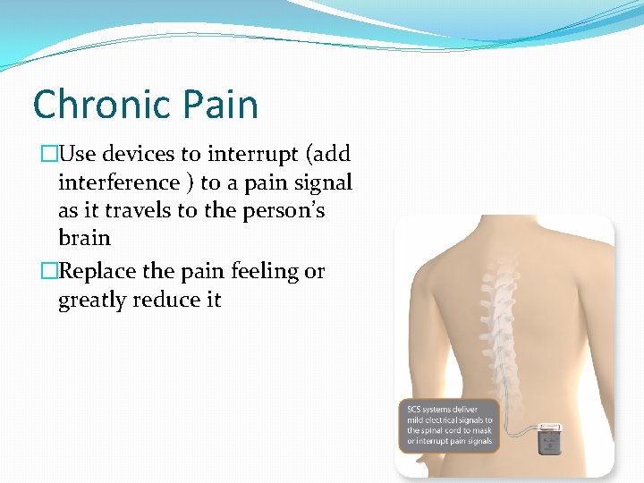 Chronic Pain �Use devices to interrupt (add interference ) to a pain signal as
