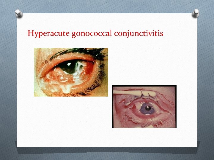 Hyperacute gonococcal conjunctivitis 