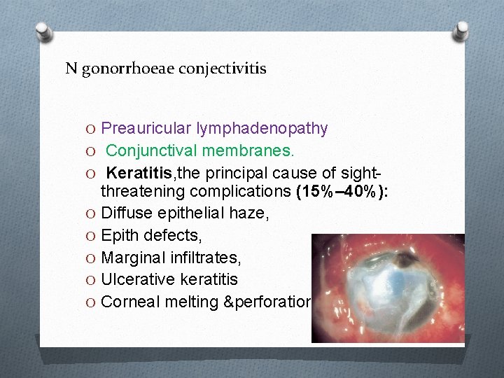 N gonorrhoeae conjectivitis O Preauricular lymphadenopathy O Conjunctival membranes. O Keratitis, the principal cause