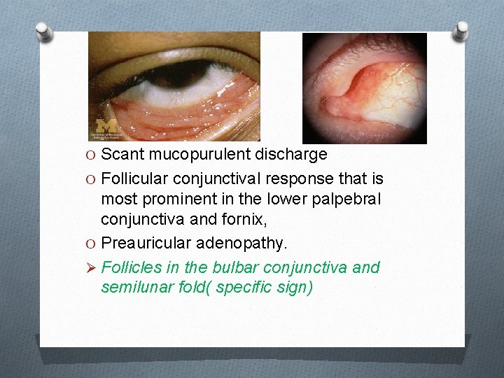 O Scant mucopurulent discharge O Follicular conjunctival response that is most prominent in the