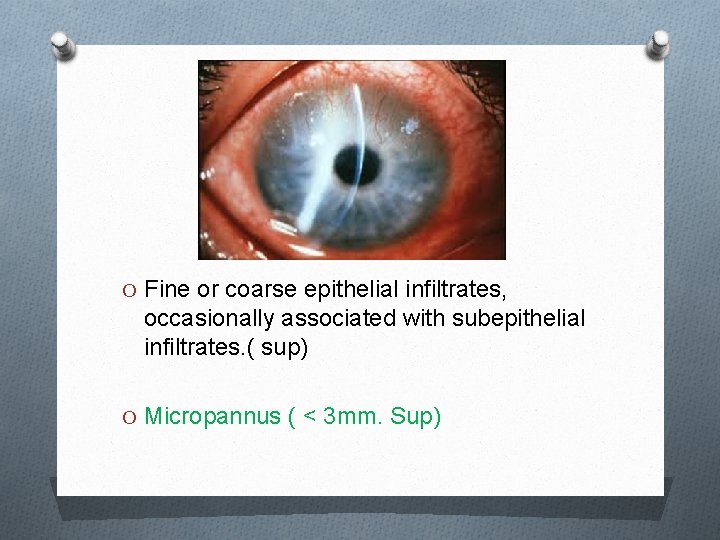 O Fine or coarse epithelial infiltrates, occasionally associated with subepithelial infiltrates. ( sup) O