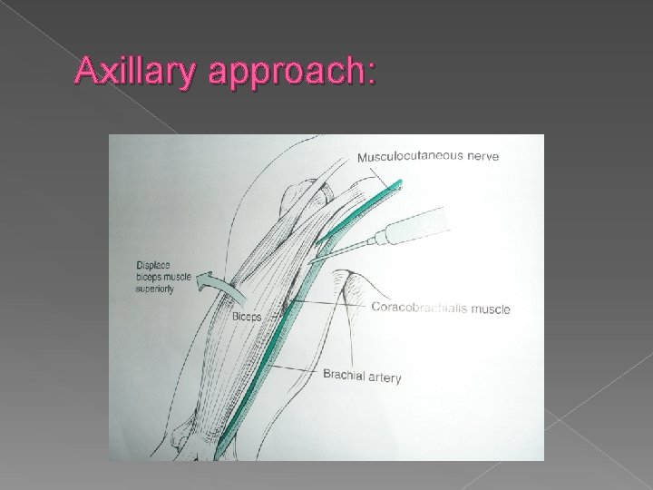 Axillary approach: 