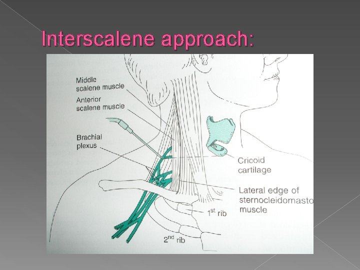 Interscalene approach: 