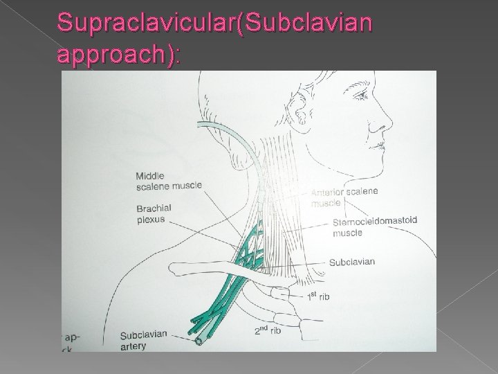Supraclavicular(Subclavian approach): 