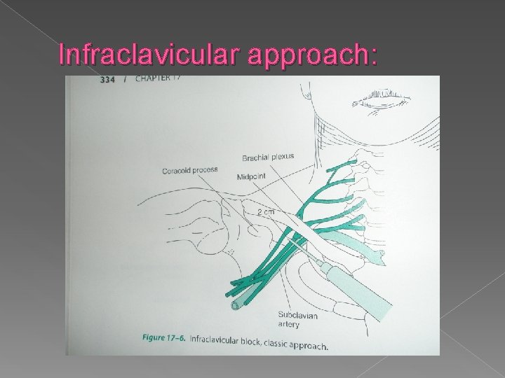 Infraclavicular approach: 