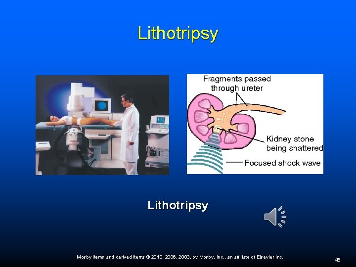 Lithotripsy Mosby items and derived items © 2010, 2006, 2003, by Mosby, Inc. ,