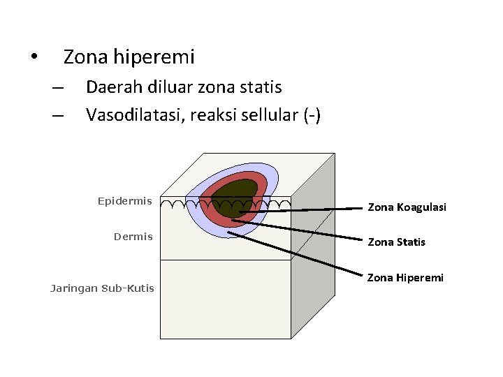 Zona hiperemi • – – Daerah diluar zona statis Vasodilatasi, reaksi sellular (-) Epidermis