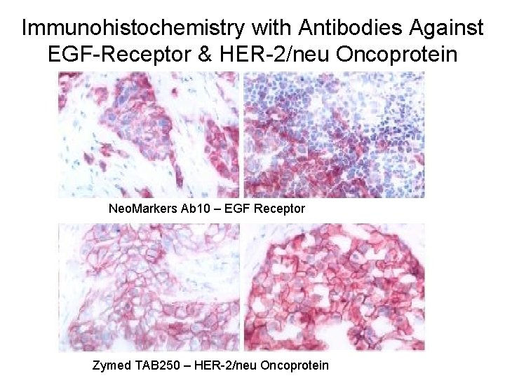 Immunohistochemistry with Antibodies Against EGF-Receptor & HER-2/neu Oncoprotein Neo. Markers Ab 10 – EGF