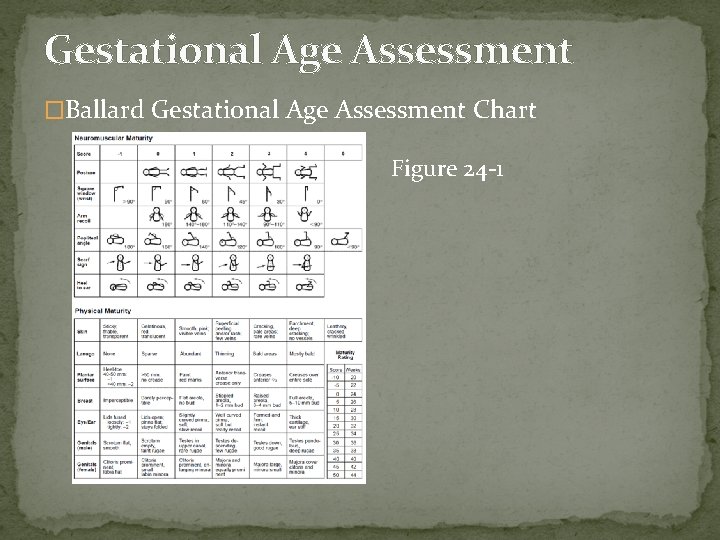 Gestational Age Assessment �Ballard Gestational Age Assessment Chart Figure 24 -1 