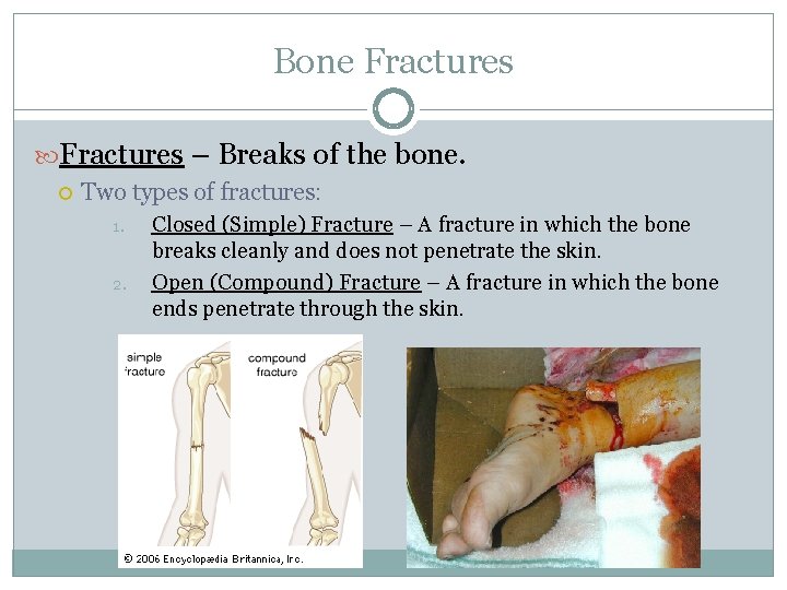 Bone Fractures – Breaks of the bone. Two types of fractures: 1. 2. Closed