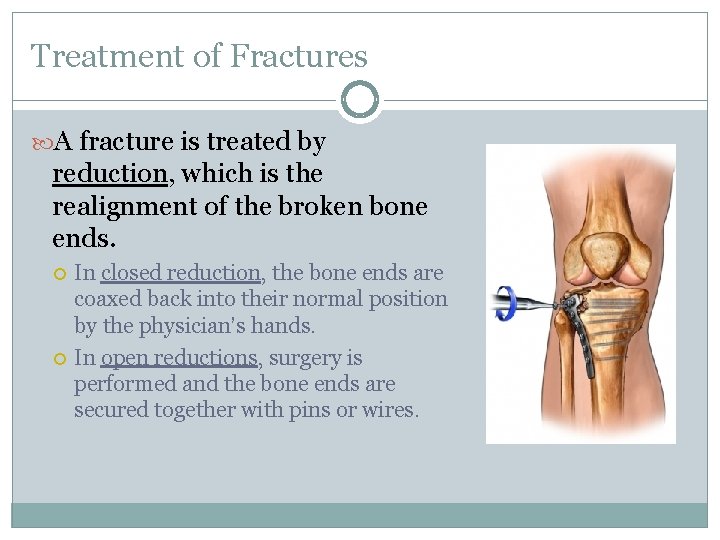 Treatment of Fractures A fracture is treated by reduction, which is the realignment of