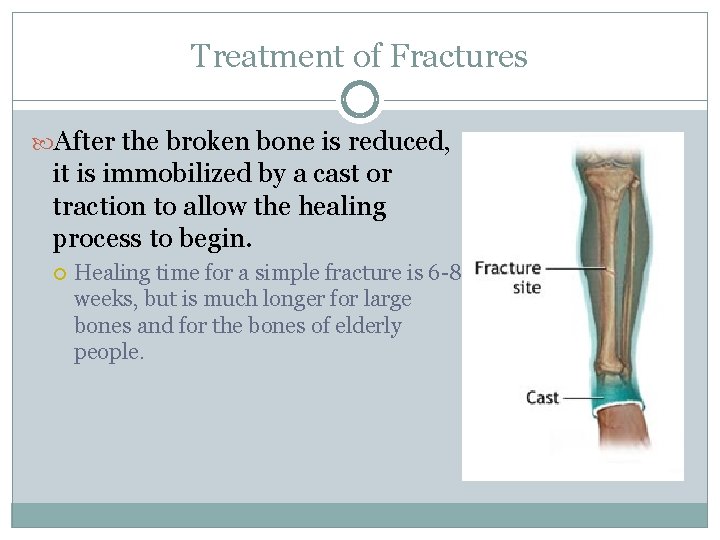 Treatment of Fractures After the broken bone is reduced, it is immobilized by a