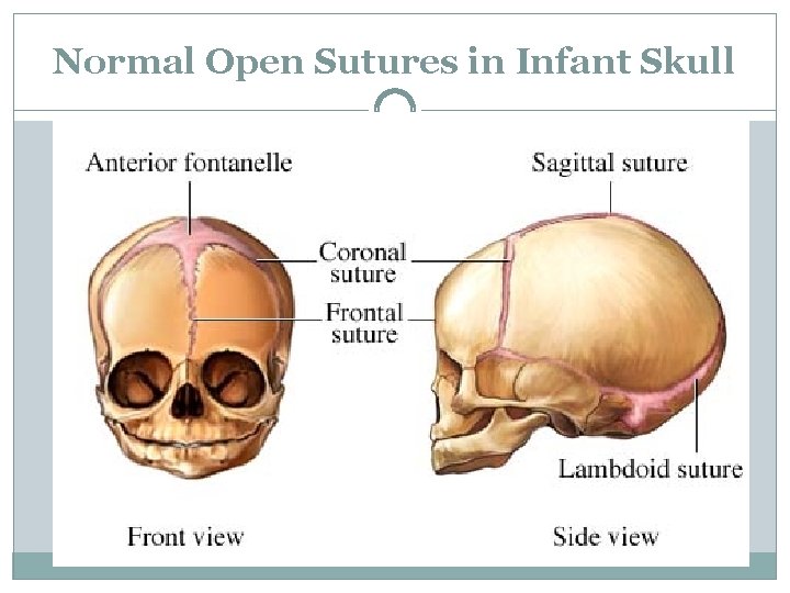 Normal Open Sutures in Infant Skull 