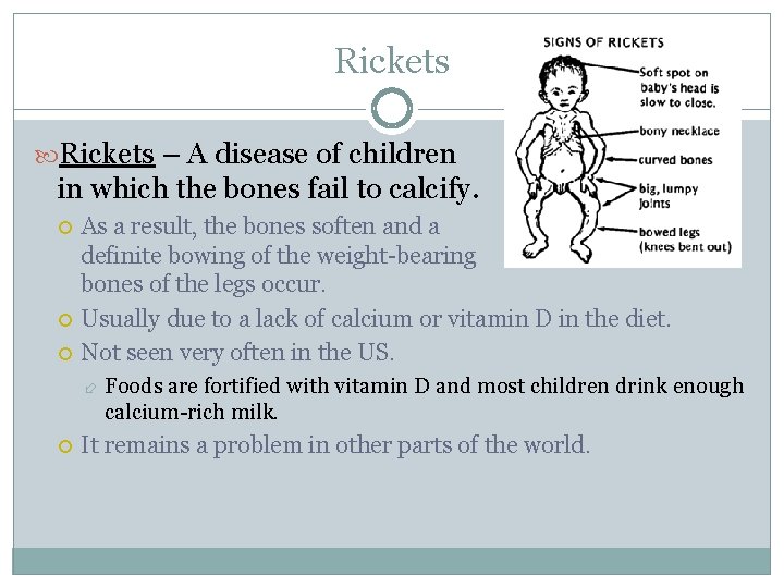 Rickets – A disease of children in which the bones fail to calcify. As
