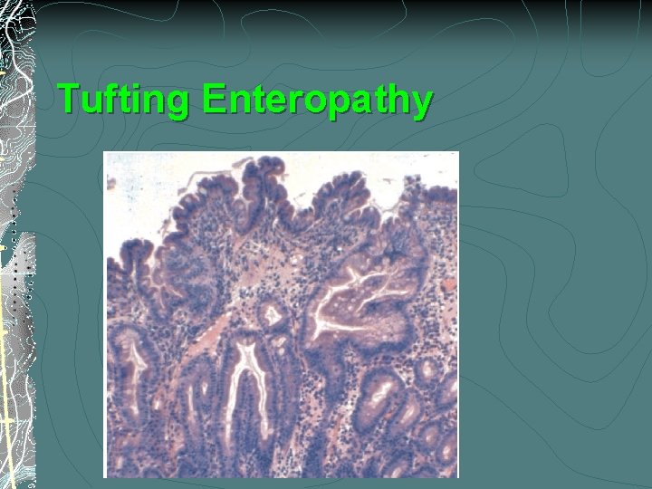 Tufting Enteropathy 