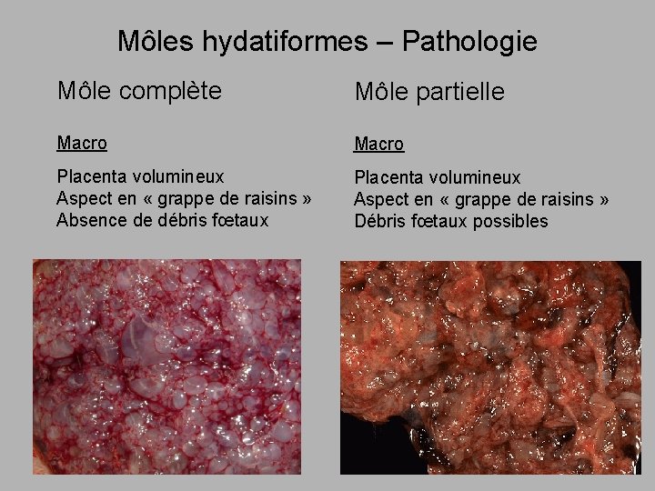 Môles hydatiformes – Pathologie Môle complète Môle partielle Macro Placenta volumineux Aspect en «