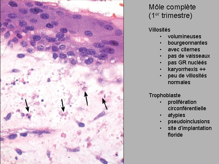Môle complète (1 er trimestre) Villosités • volumineuses • bourgeonnantes • avec citernes •