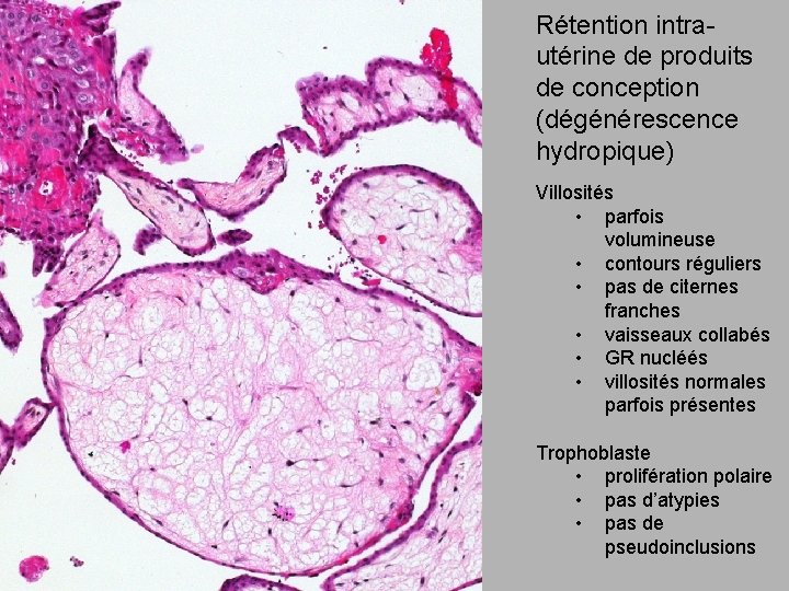 Rétention intrautérine de produits de conception (dégénérescence hydropique) Villosités • parfois volumineuse • contours